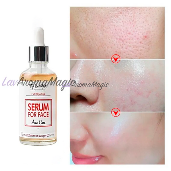 Сироватка для проблемної шкіри обличчя Top Beauty Anti Acne Serum TBAA-5829 фото